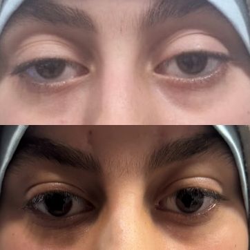 Ptosis Cerrahisi