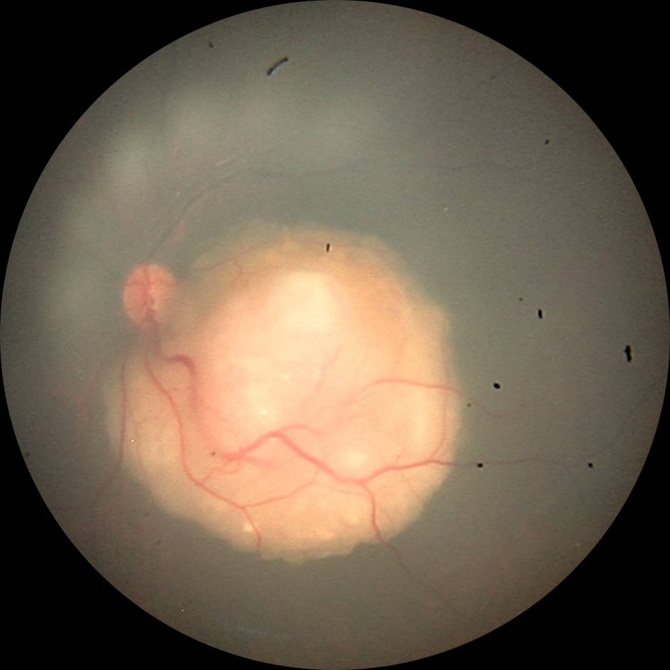 Retinoblastom